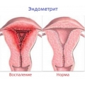 Эндометрит симптомы и лечение после родов
