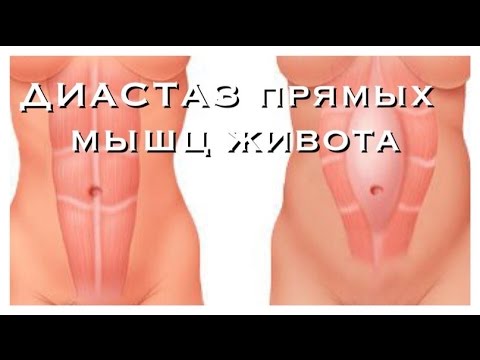ДИАСТАЗ прямых мышц живота после РОДОВ! - YouTube