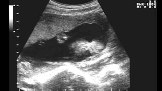 Пятый месяц беременности: фото живота на 5 месяце