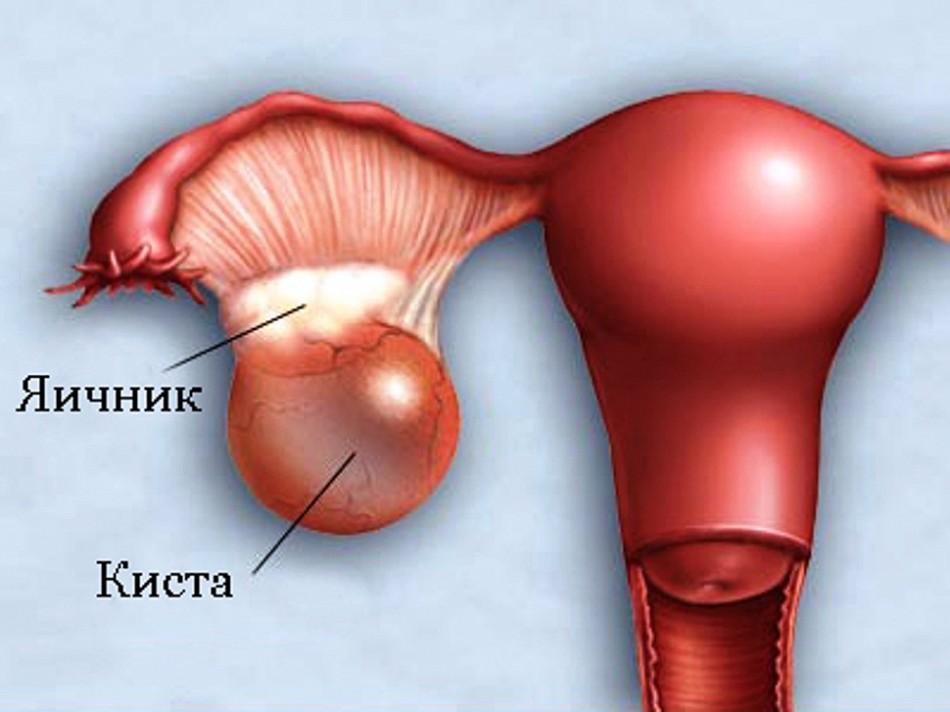 Если на правом яичнике у женщины появляется киста, у нее с этой стороны возникает боль.