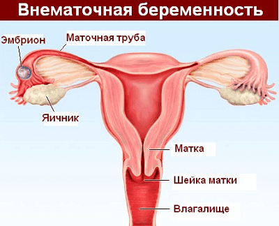 Беременность вне матки