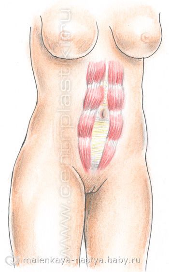 Диастаз (расхождение) прямых мышц живота после родов.