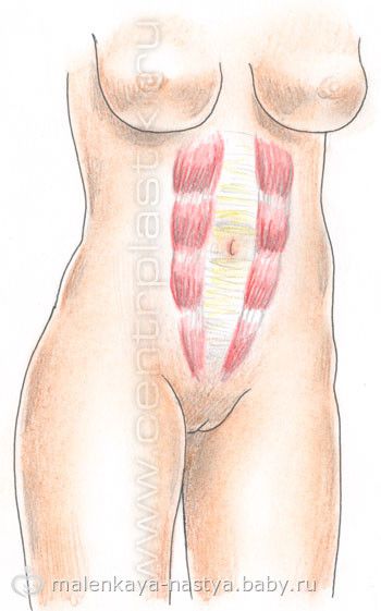 Диастаз (расхождение) прямых мышц живота после родов.