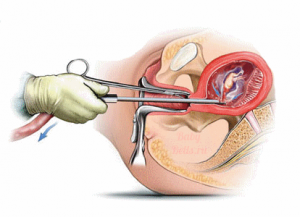 Чистка матки после родов делается ручным либо вакуумным методом