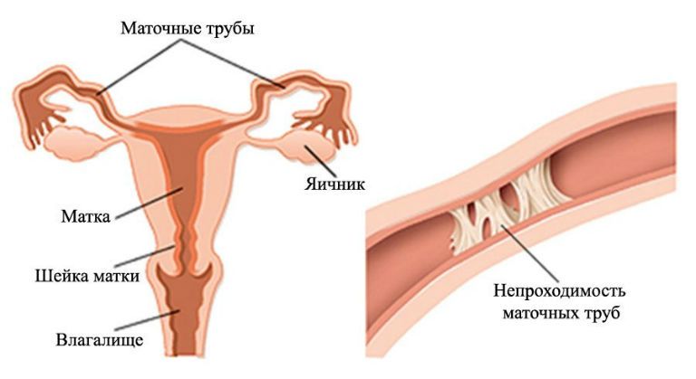 Внематочная беременность лечение после операции